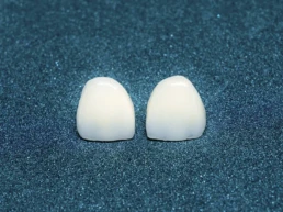Beneficiile fatetelor dentare