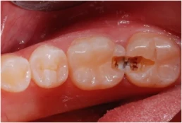 Carie interdentara JoliDent Buzau
