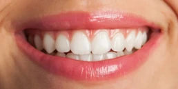 Fatate dentare au o estetica superioara si intretinere usoara
