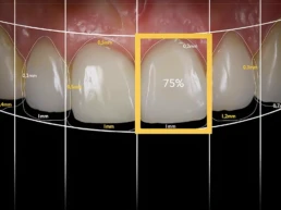 Fatete dentare cu tehnologia digitala DSD – Digital Smile Design