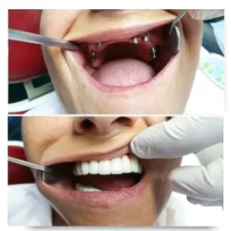 Lucrare fixa pe implanturi maxilar superior