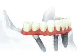Restaurari All-on-4, implanturi dentare clinica JoliDent, stomatologie in Buzau