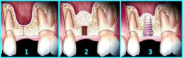 Sinus lift clinica stomatologica JoliDent Buzau